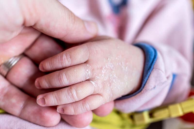 Kulit Bayi Kering & Mengelupas: Penyebab, Cara Mengatasi, dan Perawatan Aman Kulit Bayi Kering & Mengelupas: Penyebab, Cara Mengatasi, dan Perawatan Aman