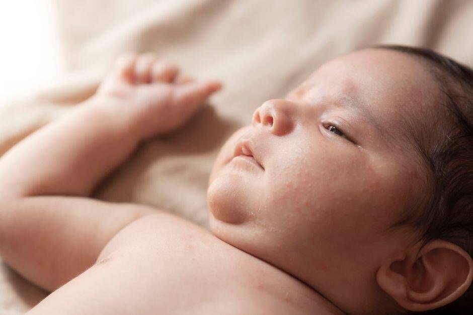 7 Ciri-Ciri Biang Keringat pada Bayi yang Perlu Bunda Kenali 7 Ciri-Ciri Biang Keringat pada Bayi yang Perlu Bunda Kenali
